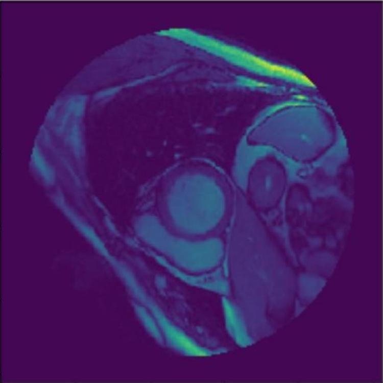 Left Ventricle Segmentation and Volume Estimation on Cardiac MRI Using Deep Learning