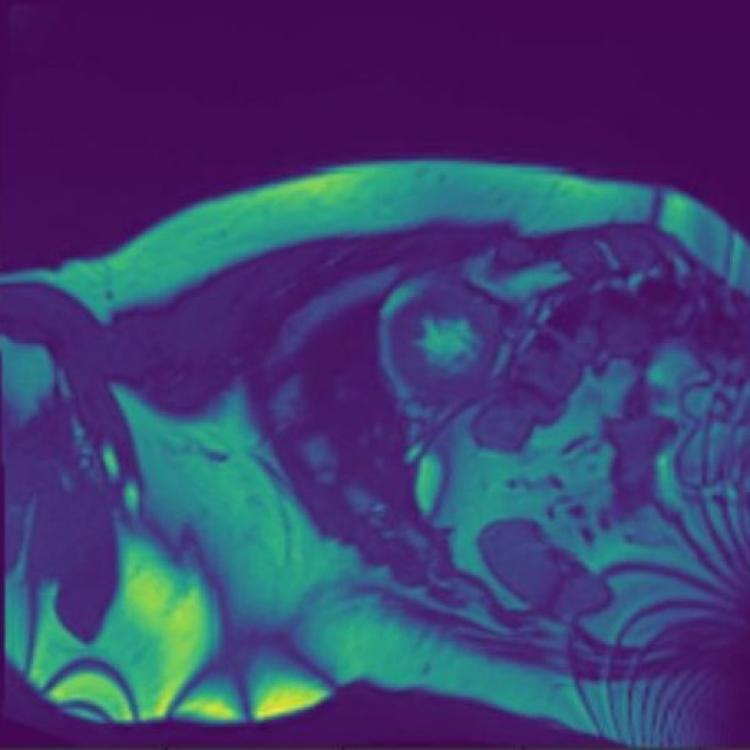 Analytics Pipeline for Left Ventricle Segmentation and Volume Estimation on Cardiac MRI Using Deep Learning